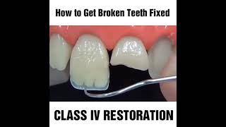 How to fix a chipped cracked or broken tooth MyDentCart  Cracked tooth repair  Broken Tooth [upl. by Nennarb148]