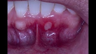 Treating an Aphthous Ulcer with Debacterol [upl. by Irakab]