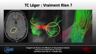 IRM de Tenseur de Diffusion et Trauma Crânien  Etat de lArt et Perspectives [upl. by Aime]