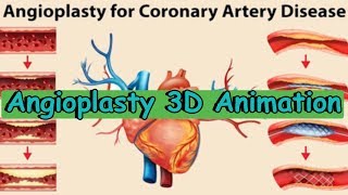 angioplasty angioplasty processangioplasty 3d animation [upl. by Katharyn571]