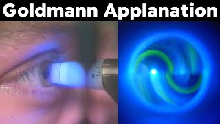 Goldmann Applanation Tonometry Procedure Technique Tutorial [upl. by Sevy485]