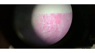 Bronchiectasis  Slide 14  Respiratory Pathology [upl. by Alue]