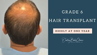 GRADE 6 Extensive Baldness Hair Transplant [upl. by Nonnelg]