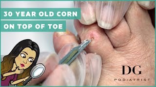 30 year old corn on top of toe [upl. by Xino252]