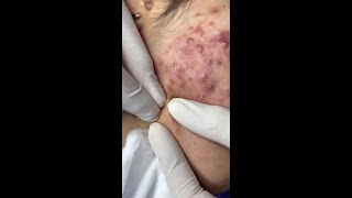 Best Pimple Popping 10 beautiful blackheads sacdepspa [upl. by Bekha]