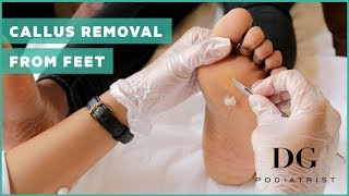 Callus removal from feet balls of feet [upl. by Nomled378]