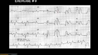 1215 Lead ECG Exercise  9 [upl. by Siramed180]