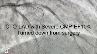 CTO LAD ISR  diffuse distal to apical Turned down from surgery Successful Revascularization [upl. by Yrrat]