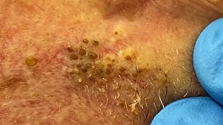 Extremely Clogged Pores Extracted  Contour Dermatology [upl. by Avram]