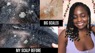 How I cleared Seborrheic Dermatitis amp Healed my scalp NOT SPONSORED  Giveaway [upl. by Yeliac]