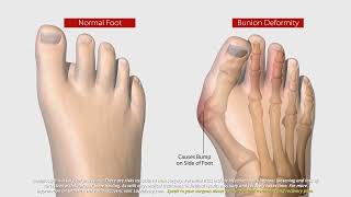 What Is Lapiplasty® 3D Bunion Correction®  All About The Lapiplasty® Procedure [upl. by Yud929]