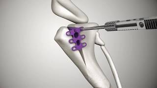 Tibial Tuberosity Advancement TTA RAPID [upl. by Etrem593]