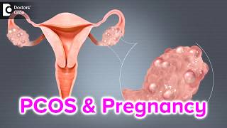 What happens if I have PCOS and I get pregnant  Dr Bala R [upl. by Letizia]