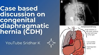 Congenital diaphragmatic herniaa case based discussion Dr Sridhar Kalyanasundaram [upl. by Yrovi]