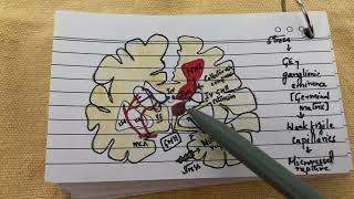 Germinal matrix hemorrhage grading  for exam going pg students [upl. by Earleen]