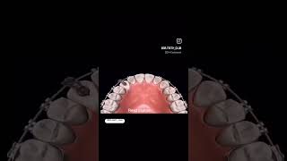 Removal of impacted maxillary Canine 🦷 Correction done by Orthodontics dr dentist teeth [upl. by Nickolas]