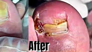 Pain free infected Ingrown Toenail Removal by a Podiatrist  Pedicure treatment amp how to cut remove [upl. by Nona]