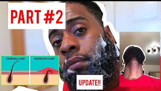 I Have A HUGE😫 Ingrown Hair  DIY Ingrown hairRazor Bump Treatment for Beards Part2 ACTION [upl. by Airlee965]