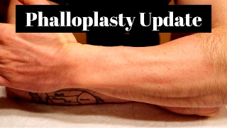 FTM Phalloplasty  Electrolysis Update [upl. by Eppillihp343]