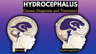 Hydrocephalus Causes Signs and Symptoms Diagnosis and Treatment [upl. by Yukio134]