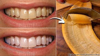 Teeth Whitening in Just 2 Minutes  Turn Yellowing and Tartar Buildup into Shiny Milky White 🦷 [upl. by Eleen]