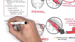 Intracranial Haemorrhage Types signs and symptoms [upl. by Wendolyn]