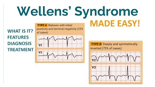 NOTTOMISS condition Wellens syndrome [upl. by Carrel53]