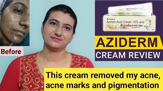 This cream removed my acne acne marks and pigmentation  Aziderm azelaic acid cream review telugu [upl. by Rim]