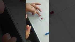 Blood group test  Ist try  youtubeshorts  medico  bloodgroup [upl. by Haodnanehs]