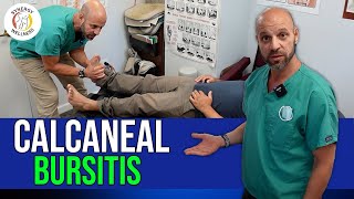 Calcaneal Bursitis  Ankle Pain [upl. by Tacita541]