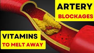 Remove Artery Plaque Top 6 Vitamins to Naturally Remove Plaque from Arteries  Boost Heart Health [upl. by Aleicarg590]