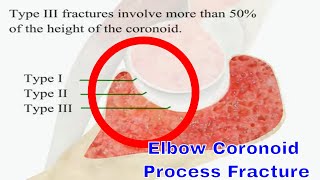 Coronoid Fracture of the Elbow Treatment Options and Recovery [upl. by Anyrak795]