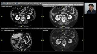 Spectral Imaging  Pancreas [upl. by Enaillil]