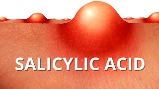 Heres WHY Salicylic Acid is Best For ACNE [upl. by Mailliwnhoj179]