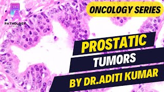 PROSTATIC TUMORS EXPLAINED  By Dr Aditi Kumar [upl. by Lednik]