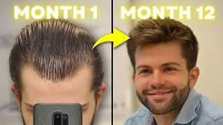 How I Regrew My Hair Using 3 Proven Treatments MonthbyMonth Results [upl. by Gerry46]