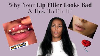 What Makes Lip Filler Look Bad  How To Fix Lip Filler Problems  Top Lip Filler Tips [upl. by Lamarre93]