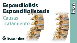 Espondilolisis y espondilolistesis  Qué es causas síntomas y tratamiento [upl. by Sig]