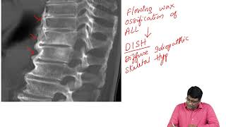 Ankylosing Spondylitis Vs DISH [upl. by Ennovoj606]