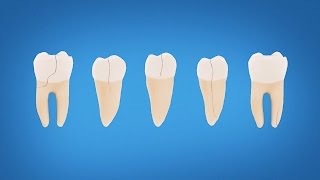 Understanding Cracked Tooth Treatment and Symptoms [upl. by Zat]