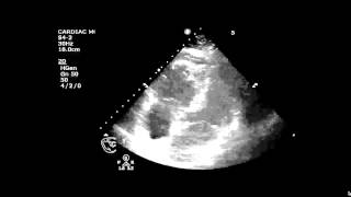 Pulmonary Embolus McConnells Sign [upl. by Aieki]