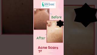 Acne Scars Treatment  Dr Bhoomi Goel  Public Hospital [upl. by Ramoj841]