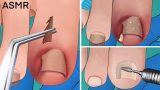 ASMR Ingrown toenail removal treatment foot care animation  Satisfying tingle [upl. by Nessaj]