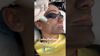 Carbon Laser Facial getsmarthairclub skintreatment shorts shortvideo shortsfeed [upl. by Levitt]