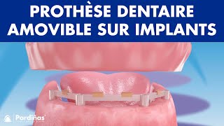 Prothèse dentaire amovible sur implants © [upl. by Alegnasor]