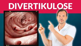 Divertikulose vermeiden Entzündung Divertikulitis muss nicht sein [upl. by Melan]