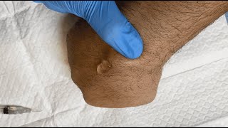 Drainage of a Ganglion Cyst [upl. by Hancock]