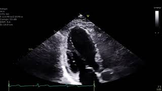 Mid Wall Stress Cardiomyopathy [upl. by Algie]