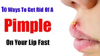 10 Ways To Get Rid Of A Pimple On Your Lip Fast [upl. by Faustina430]