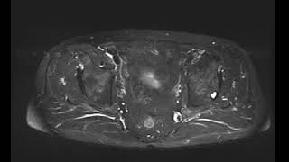 Ischial bursitis [upl. by Ryan]